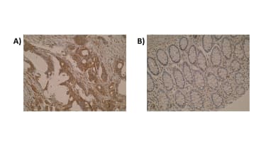 Figure. Immunohistochemistry was performed on primary colorectal tumour (A) and normal colon mucosa (B) using anti-GCSP [Z44P4C6*F5]. Cytoplasmic localisation of GCSP is observed.