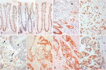 Clone PPG5/25 used to detect expression of ERβ5 in colorectal tissue by IHC-P. Examples of ERβ1 (a, d, e), ERβ2 (b, f, g), ERβ5 (c, h) and TFF1 (i) immunohistochemistry performed on normal colorectal epithelium (a–c) and colorectal carcinoma (d–i). Source: Wong et al. 2005. J Pathol. 207(1):53-60. PMID: 15954165.
