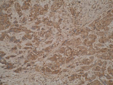 IHC performed on formalin fixed paraffin-embedded sections of breast cancer tissue probed with anti-TIMP2 antibody [3A4].