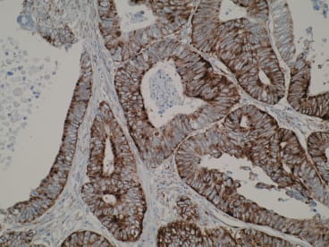 Immunohistochemistry image showing strong cytoplasmic positivity in primary colorectal cancer using Anti-ELOVL3 [V61 P2B3*D10]. IHC was performed on formalin-fixed, paraffin-embedded tissue sections. Antigen retrieval step is required (microwave 10 min @ 950W in 0.01M sodium citrate buffer, pH 6.0).
