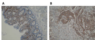 Immunohistochemistry using Anti-WSB1 [K5P2H10*E10]. (A) Cytoplasmic immunoreactivity of glandular epithelium and lamina propria cells in normal human colon. Strong staining is observed in plasma cells of the lamina propria. (B) Strong cytoplasmic immunoreactivity in primary colorectal cancer. IHC was performed on formalin-fixed, paraffin-embedded tissue sections. Antigen retrieval step is required using EDTA buffer (pH8). 