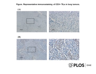 Adapted from Wang et al. 2012. PLoS One. 7(7):e39525. PMID: 22848356. Figure. Representative immunostaining of CD3+ TILs in lung tumors. (A) Representative of CD3 immunostaining of TILs in lung tumors with low TIL density (<25 CD3+/HPF) (left: 100x; right: 400x); (B) TILs presented in lung tumors show high TIL density (≥25 CD3+/HPF) (left: 100x; right: 400x).