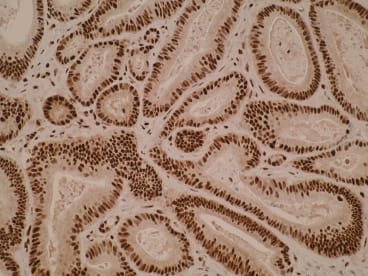 Immunohistochemistry of formalin-fixed, paraffin-embedded human colorectal cancer tissue using anti-SPATA2L [Z2P2D5*C8] showing showing exclusive strong nuclear staining.