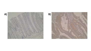 Figure. Photomicrographs of anti-Cytochrome P450 2J2 [Z9P1G9*A2]. is seen in normal colon (A) whilst in primary colorectal tumour tissue (B) moderate positive signal is detected. Cytoplasmic localisation of CYP2J2 is observed.