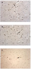 Immunohistochemical Detection of SQSTM1 in Diseased Human Brain.

10uM paraffin embedded sections were cut from Hyman  post-mortem brain (cortex) and incubated with Affinity Purified Rabbit Anti-SQSTM1 antibody (1ug/ml overnight at room temperature). Biotinylated Donkey Anti-Rabbit secondary antibody and counterstained with Haematoxylin to identify nuclei (blue).

A - Alzheimer's Disease: Neurofibrillary tangles *dark brown) are intensely stained by this antibody. 20x objective.
B - Multiple System Atrophy: Glial cytoplasmic inclusions are intensely stained by this antibody (ark brown). 20x objective.
C - Parkinson's Disease/ Lewy Body Dementia: Lewy bodies are intensely stained by this antibody (dark brown). 20x objective.