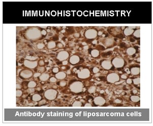 Staining of liposarcoma cells with clone F27P6A1.  Anti-Cytochrome P450 26A1 can be used neat or 1/5 diluted for IHC; antigen retrieval is through microwave 20 min @ 800W in 10 mM citrate buffer, pH 6.0