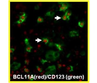 BCL11A<sub>XL</sub> (BCL123a) expression in tonsil 
BCL11AXL is present in B cells (brown) in germinal centres and mantle zones.	Double labelling studies show the strongly labelled cells in the interfollicular areas to be CD123-positive pDCs (arrowhead).