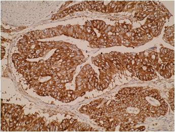 Immunohistochemical staining of human colorectal cancer tissue shows strong cytoplasmic positivity. IHC was performed on formalin-fixed, paraffin-embedded tissue sections. 