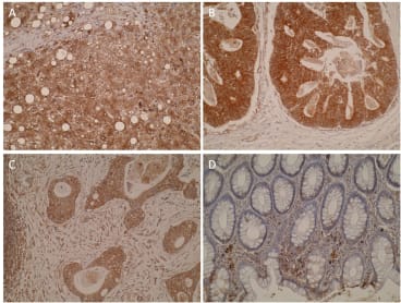 Immunohistochemistry was performed on formalin-fixed, paraffin-embedded tissue sections and showed positive cytoplasmic immunostaining in normal liver (A) which is expected as CYP7B1 is involved in bile acid synthesis. Primary colorectal (B) and metastatic colorectal tumors (C) showed stronger staining compared to normal colon mucosa (D). 