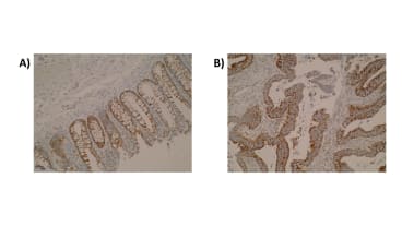 Immunohistochemistry was performed on normal colon (A) and primary colorectal tumour (B) tissue using anti-ELOVL3 [V61 P2B3*D10]. Cytoplasmic localisation of ELOVL3 was observed.