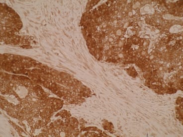 Immunohistochemistry of formalin-fixed, paraffin-embedded human colorectal cancer tissue using anti-GCSP [Z44P4C6*F5] showing strong cytoplasmic staining.