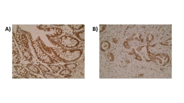 Figure. Immunohistochemistry was performed on normal colon mucosa (A) and primary colorectal tumour (B) using anti-anti-AARS antibody [M6-P2E5]. Cytoplasmic localisation of AARS is observed.