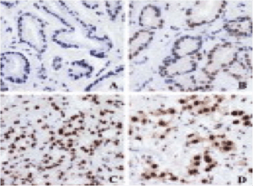 Clone PPG5/10 used to detect expression of ERβ1 in cancer tissue by IHC-P. Immunohistochemical localization of ER-β using PPG5/10 antibody. Source: Wong et al. 2005. J Pathol. 207(1):53-60. PMID: 15954165.
