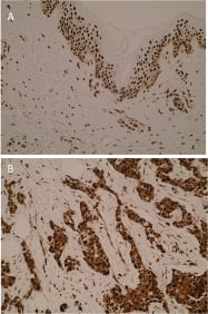 Immunohistochemistry was performed using anti-hnRNP-K (isoform1) [N10 P2D3*G2] on formalin-fixed, paraffin-embedded tissue sections.  Strong nuclear immunostaining was observed in normal skin (A). Nuclear and cytoplasmic immunostaining was observed in breast carcinoma (B). This is in agreement with existing literature as hnRNPK shows aberrant localisation in tumours.  