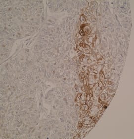 Immunohistochemical staining of human endometrial cancer tissue shows cytoplasmic positivity. IHC was performed on formalin-fixed, paraffin-embedded tissue sections. 