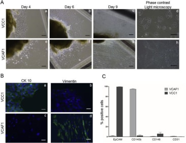 Isolation and characterization of vulva cancer cells (VCC1). Representative phase contrast images showing outgrowth of cancer cells at day 4 (a), day 6 (b) and day 9 (c) respectively. Morphology of VCC1 is mainly polygonal (d). Scale bar- 50 μm. Image modified from https://doi.org/10.1016/j.yexcr.2019.111684.