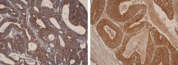 Immunohistochemistry was performed on formalin-fixed, paraffin-embedded tissue sections. Images are showing strong cytoplamic positivity of CYP26A1 in primary colorectal cancer using the Anti-CYP26A1 [F27P6A1]. Antigen retrieval step was required (microwave 10 min @ 950W in 0.01M sodium citrate buffer, pH 6.0).
