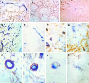 Adapted from Passalidou E, Stewart M, Trivella M, Steers G, Pillai G, Dogan A, Leigh I, Hatton C, Harris A, Gatter K, Pezzella F. Vascular patterns in reactive lymphoid tissue and in non-Hodgkin's lymphoma. Br J Cancer. 2003 Feb 24;88(4):553-9. doi: 10.1038/sj.bjc.6600742. PMID: 12592369; PMCID: PMC2377172. Vascular phenotype in reactive and neoplastic lymph nodes. LH39-positive meshwork in (A) a reactive lymph node (B) a follicular lymphoma and (C) a large B-cell lymphoma; in the latter only a few residual fragments of the LH39 meshwork are present (arrow). (D) Reactive lymph nodes: all the vessels in the paracortex are within the LH39 meshwork while (E) LH39-negative vessels are present within a germinal centre. (F) Only rare LH39-negative vessels are seen in the paracortex in Follicular lymphomas (arrow) while (G) some more are present in the neoplastic follicles (arrows). Sequence of vascular regression: (H) A normal vessel in which the endothelial cells and the LH39-positive basal membrane are superimposed. (I) early detachment of the endothelial cells from the basal membrane. (J,K) Progressive fragmentation of both endothelial cells and basal membrane leading to vascular regression.