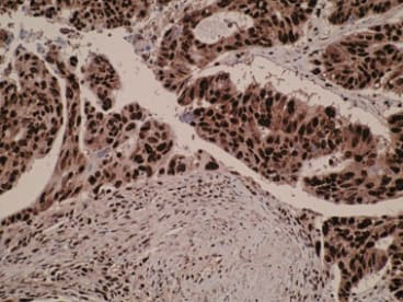 Positive immunostaining is observed in colorectal cancer tissue sections and staining is predominately nuclear. IHC was performed on formalin-fixed, paraffin-embedded tissue sections.