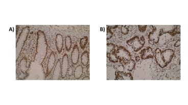 Figure. Immunohistochemistry was performed on normal colon (A) and primary colorectal tumour (B) tissue using anti-SPATA2L [Z2P2D5*C8]. Cytoplasmic localisation of SPATA2L was observed in a subset of colorectal tumours.