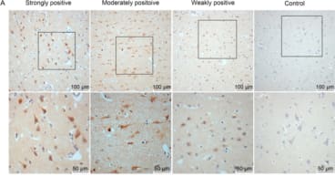 Adapted from Wang et al. 2017. Virol Sin; 32(5):423-430. PMID: 29116594 Figure. EBV expression in brain tissues of RE patients and controls. (A) Representative images of strong, moderate, and weak positive staining and negative staining for EBV antigen under low (scale bar = 100 µm) and high (scale bar = 50 µm) magnification.