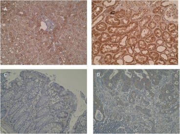 Immunohistochemistry was performed on formalin-fixed, paraffin-embedded tissue sections and showed positive cytoplasmic immunostaining in normal liver (A) and normal kidney (B) as reported by literature. Primary colorectal (C) and metastatic (D) colorectal tumors showed moderate staining compared whilst normal colon mucosa was negatively stained. 