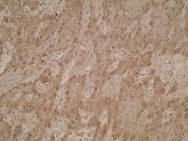 Immunohistochemistry was performed on formalin-fixed paraffin-embedded hepatocellular carcinoma tissue  sections using anti-CML28 [V80P1C10*C]. Cytoplasmic staining was observed.