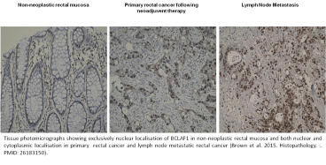 Tissue photomicrographs showing exclusively nuclear localisation of BCLAF1 in non-neoplastic rectal mucosa and both nuclear and cytoplasmic localisation in primary  rectal cancer and lymph node metastatic rectal cancer (Brown et al. 2015. Histopathology. :. PMID: 26183150).
