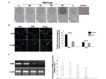 Clone PPG5/25 used to detect ERβ5 expression thymic tumors by Immunofluorescence. (A)Overexpression of cytoplasmic ERβ5 was observed in thymic carcinomas and thymomas, compared with the normal thymic tissues. (B) ERβ5 expression was observed in the T1682 and TC1889 cell lines through indirect immunofluorescence. (C) The results revealed that the mean level of ERβ5 gene expression was lower in advanced clinical stages. ERβ5, estrogen receptor β5. Source: Li et al. 2015. Oncol Lett. 10(4):2341-2346. PMID: 26622848.
