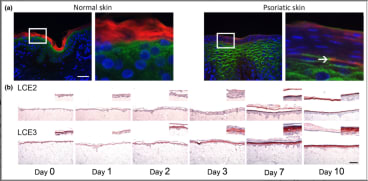 Epidermal localization of late cornified envelope (LCE)2 and LCE3 proteins. (a) Immunofluorescence double labelling of anti‐LCE2 (red signal) and anti‐LCE3 (green signal) in normal and psoriatic skin. Nuclei are stained with 4ʹ,6‐diamidino‐2‐phenylindole (blue signal). The right panel for both skin conditions shows a magnification inlay corresponding to the white box in the left panel. (b) Immunohistochemical staining of LCE2 (upper panel) and LCE3 (lower panel) proteins in three‐dimensional skin equivalents during skin morphogenesis. Scale bar = 100 μm.