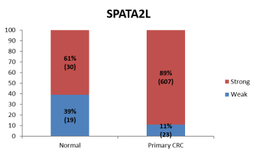 The frequency distribution of the intensity of expression of nuclear SPATA2L in normal colonic mucosa and primary colorectal cancer using Anti-SPATA2L [Z2P2D5*C8]. All monoclonal antibodies developed by VAL have been independently validated by the Department of Pathology, University of Aberdeen and the Grampian Biorepository. Each antibody has been tested by immunohistochemistry against a multi-tumour tissue microarray containing 16 tumour types matched with normal tissues. To identify clinical significance of targets of interest, corresponding antibodies have also been used to screen a large colorectal cancer tissue microarray (n=650). For further information and future collaboration please contact Professor Graeme Murray (g.i.murray@abdn.ac.uk).