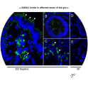 Adapted from Sena et al. 2013. PLoS One. 8(10):e76969. PMID: 24130820. Figure. Decrease in ANXA1 levels in affected areas of the gut in patients with CD. Indirect immunofluorescence using a mouse anti-human ANXA1 antibody is shown with sections of colon resections from non-IBD (A-C) and IBD patients (D-E) by confocal microscopy analysis. (A) ANXA1 protein is localized in cytoplasm of the epithelial cell layer (arrowheads) and dispersed leukocytes in the mucosa in the crypt (B) and villus (C). (C) Non-IBD submucosal PMN (arrowheads) show increased levels of immunolabeling for ANXA1 in the cytoplasm in contrast to IBD patients. (D) ANXA1 protein is not detected in the crypt enterocytes and (E) weakly observed in some submucosal leukocytes (arrowhead) from IBD samples (Magnification 400×)