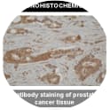 Immunohistochemistry: antibody staining of prostate cancer tissue