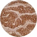 Immunohistochemical staining of human colorectal cancer tissue shows strong cytoplasmic positivity. IHC was performed on formalin-fixed, paraffin-embedded tissue sections. 