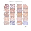 Adapted from Espinosa et al. 2013. PLoS One. 8(2):e55975. PMID: 23405241
Figure. Histological analysis of marker genes. Protein expression was determined by immunohistochemistry using sections from formalin-fixed, paraffin-embedded tissue. Proteins explored were CDKN3A, SYCP2, PRC1, CDC20, CCNB2, PCNA, CDKN2A, MKI67, and CDC2. Representative experiments in adeno cell carcinomas (panel A) and squamous cell carcinomas (panel B) are shown. The specific signals are shown as brown staining (counterstained with hematoxylin; original magnification, ×400; bars, 10 µm).