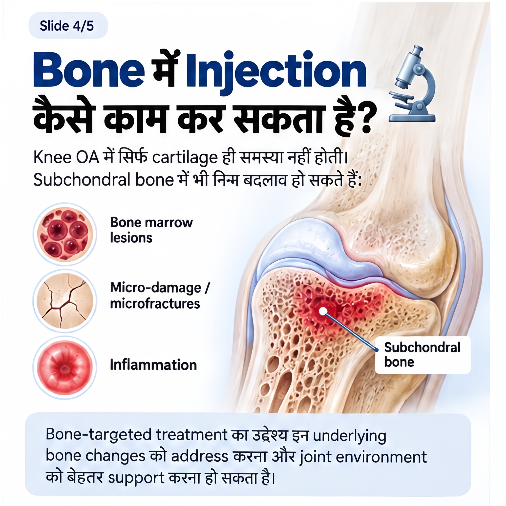 Subchondral bone damage: bone marrow lesions, microfractures, inflammation