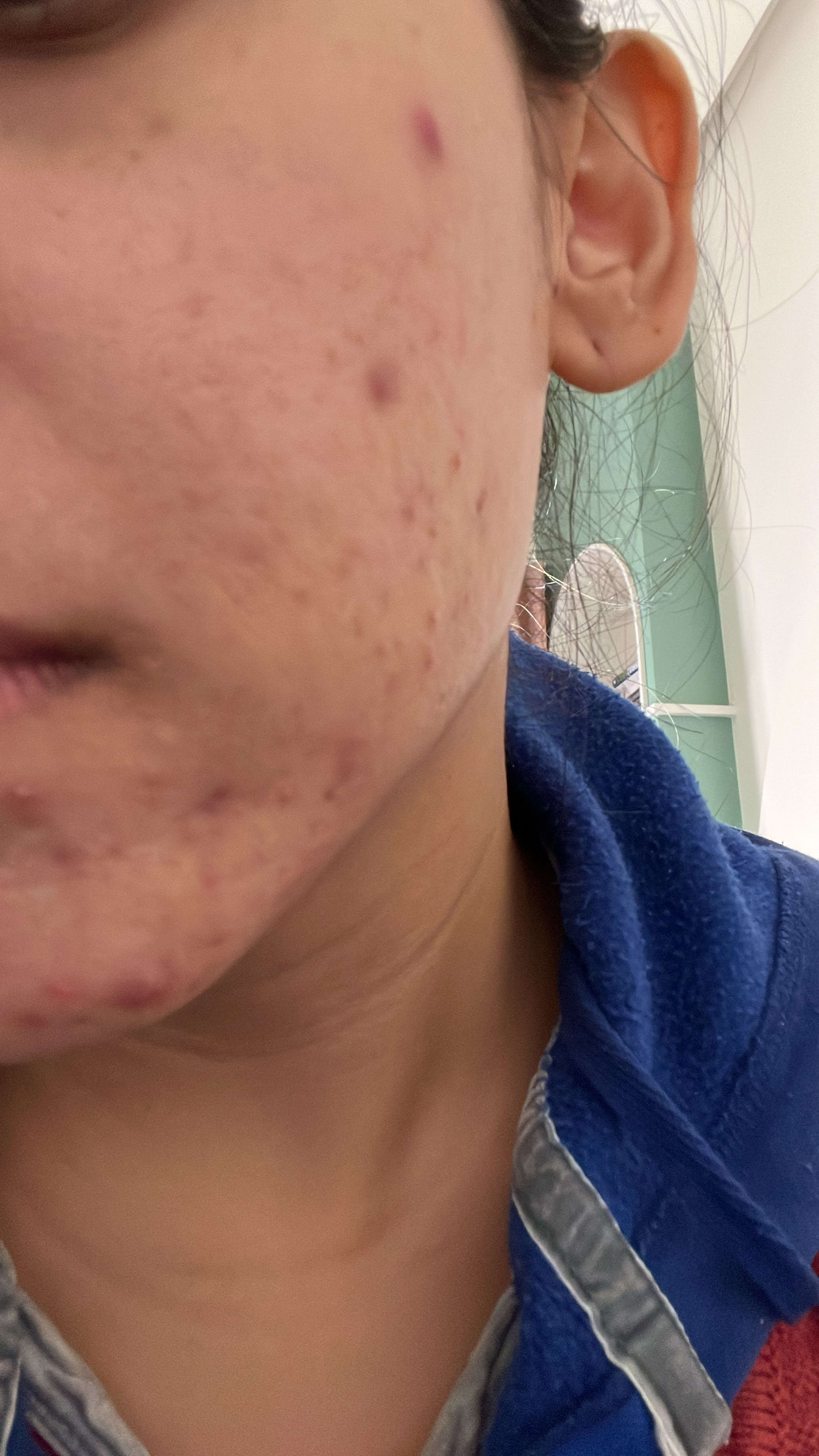 Vandita acne before