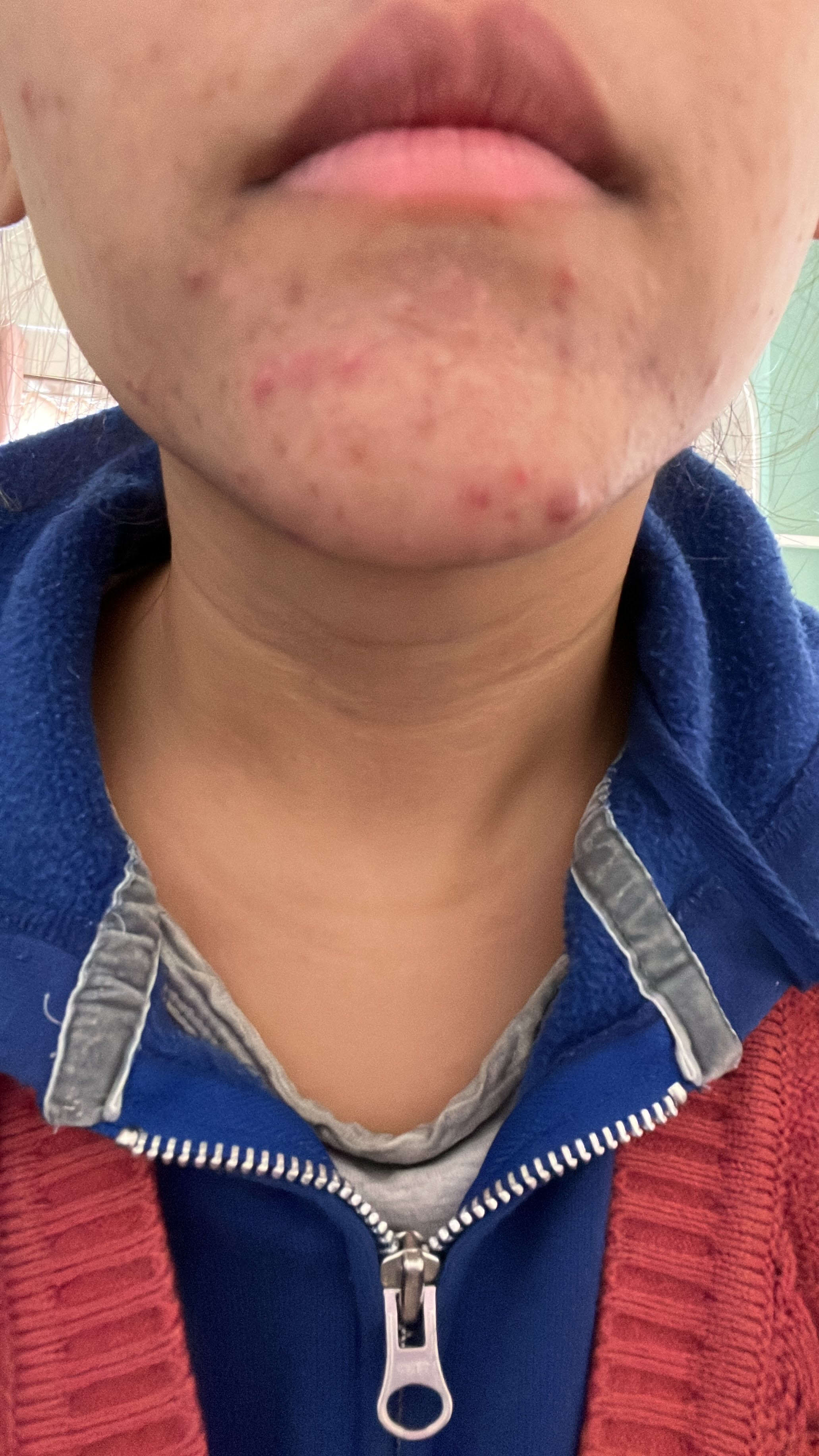 Vandita acne before
