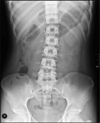 An Example of Abdominal X-ray