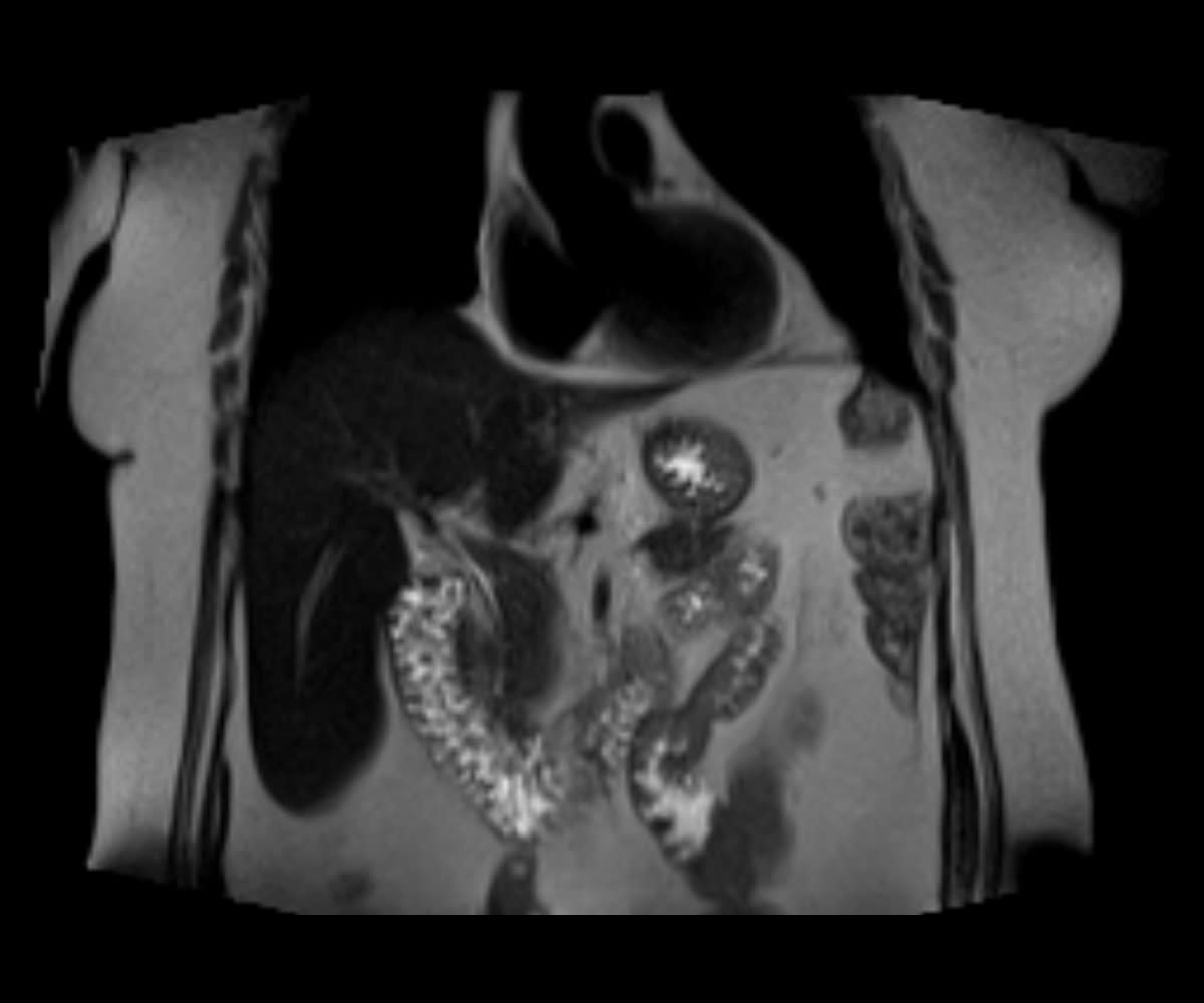 An Example of Abdominal MRI