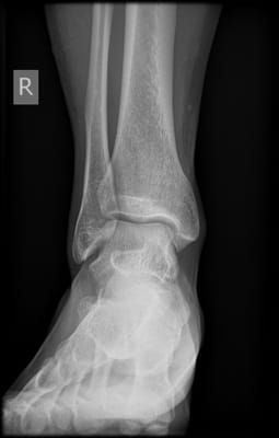 An Example of Ankle X-Ray