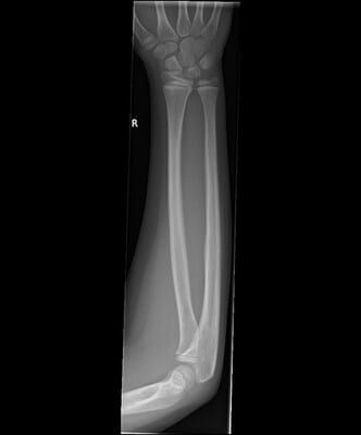 An Example of Arm X-ray