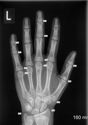 An Example of Bone Age X-ray