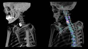 An Example of Detailed CT Bone Scan