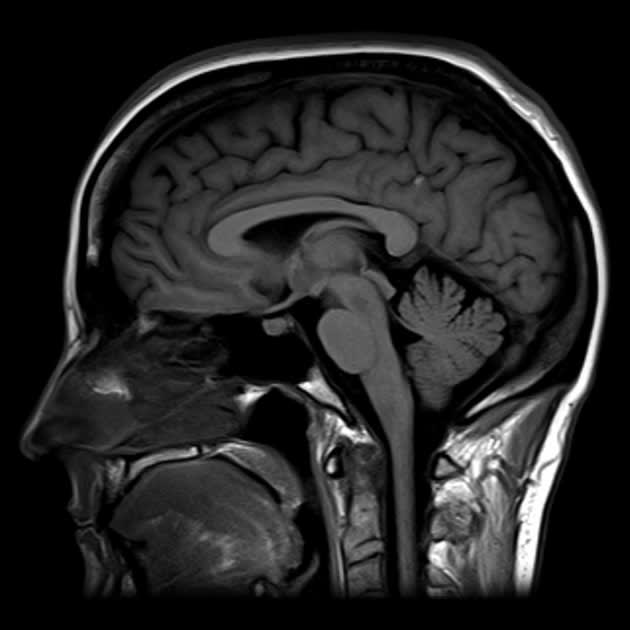 An Example of Brain MRI