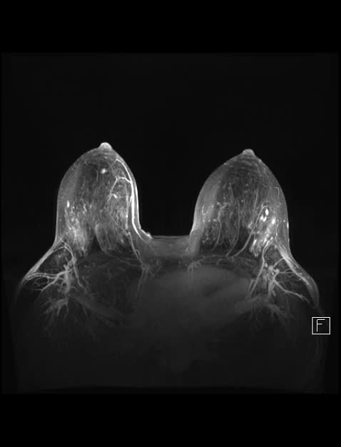 An Example of Breast MRI