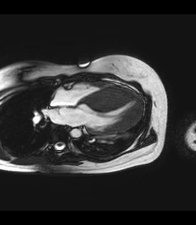An Example of Cardiac MRI