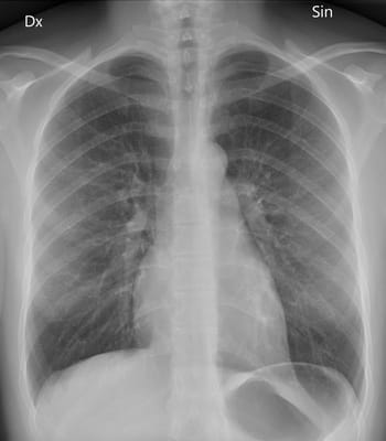 An Example of CXR