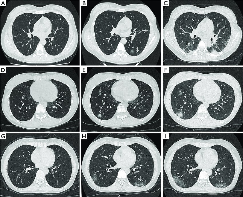 An Example of Detailed Chest CT Scan