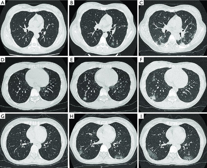 Thorax Ct Scan 306x226